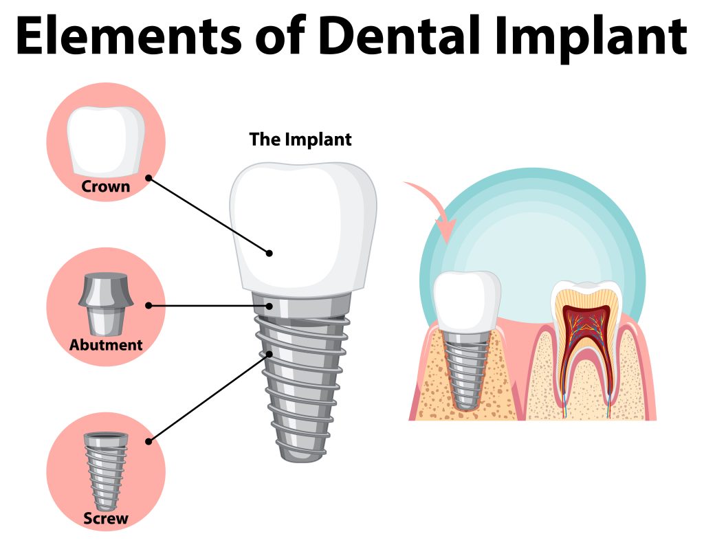 dental implants